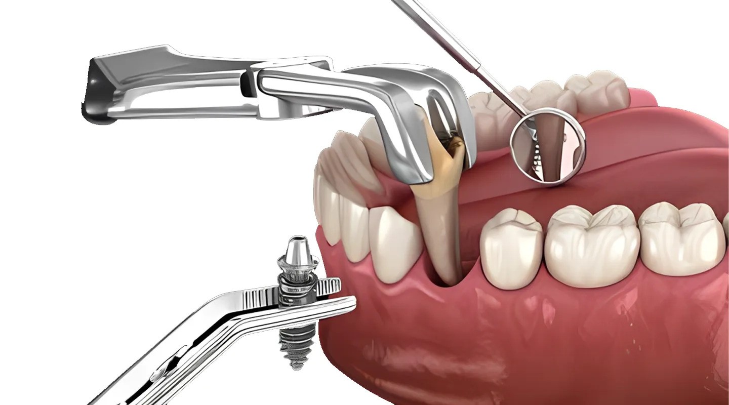 Dental Implants